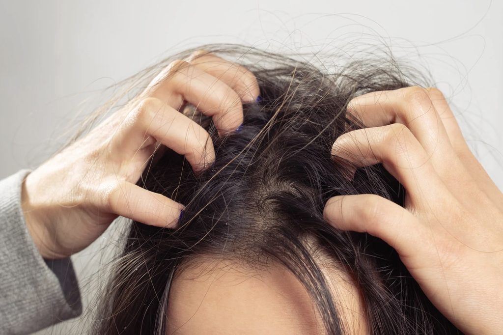 Itchy scalp in Singapore